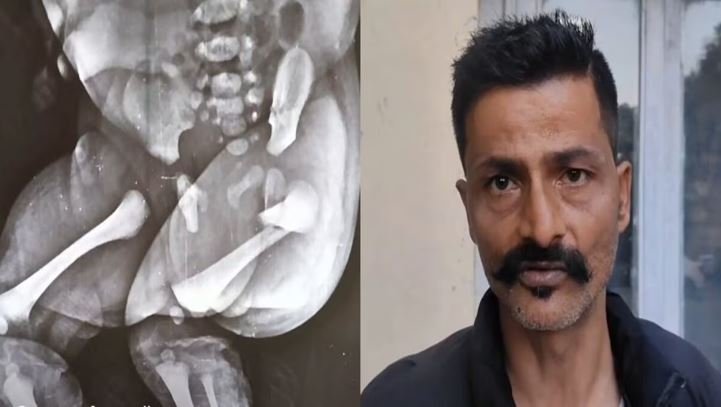 हिमाचल प्रदेशः डिलीवरी के दौरान बच्चे को खींचकर बाहर निकाला, नवजात की टांग टूटी, डॉक्टर पर लापरवाही के आरोप, स्वास्थ्य मंत्री से मिले पिता